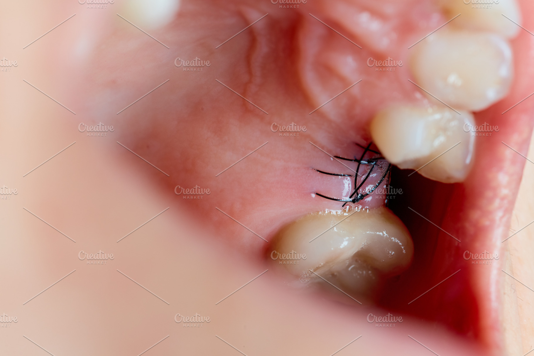 closeup-on-suture-after-dental-implant-surgery-health-medical-stock