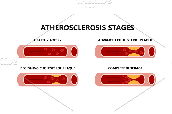 Atherosclerosis formation. Healthy | Pre-Designed Vector Graphics ...