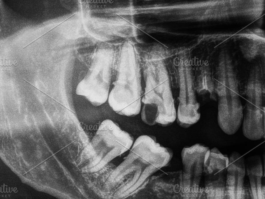 Повторный снимок. Рентген снимок зубов человека. Зубы на рентгеновском снимке. Зубы человека ренгтнег.