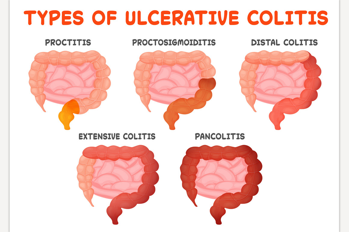 Ulcerative colitis types Healthcare Illustrations Creative Market