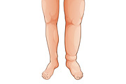 Edema lymphedema disease | Healthcare Illustrations ~ Creative Market