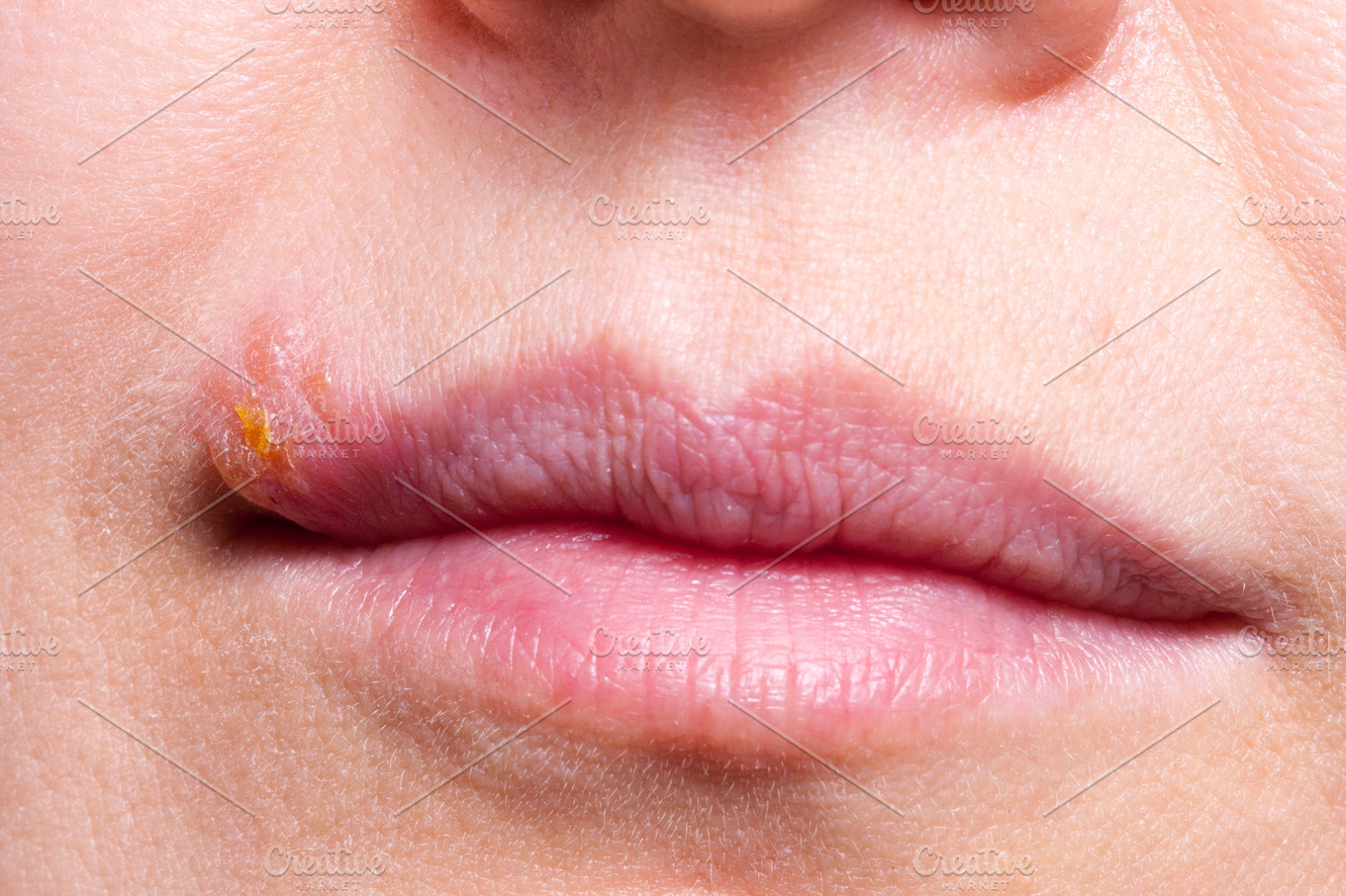 Herpes On The Lip Close Up Macro Containing Problem Illness And Face Health And Medical Stock 