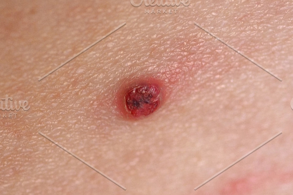 Surgical Removal Of Pyogenic Granuloma On Skin High Quality Stock