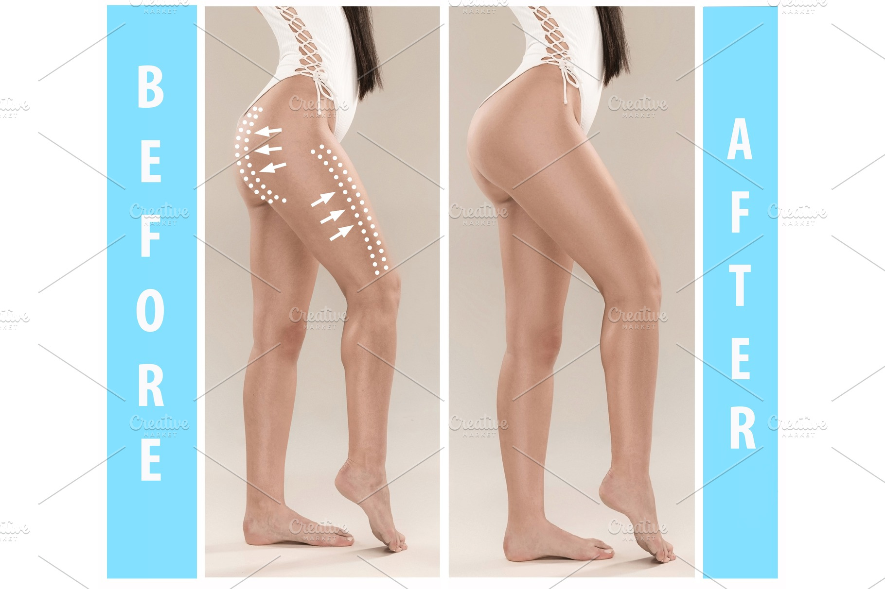 woman-s-buttocks-before-and-after-plastic-surgery-stock-photo