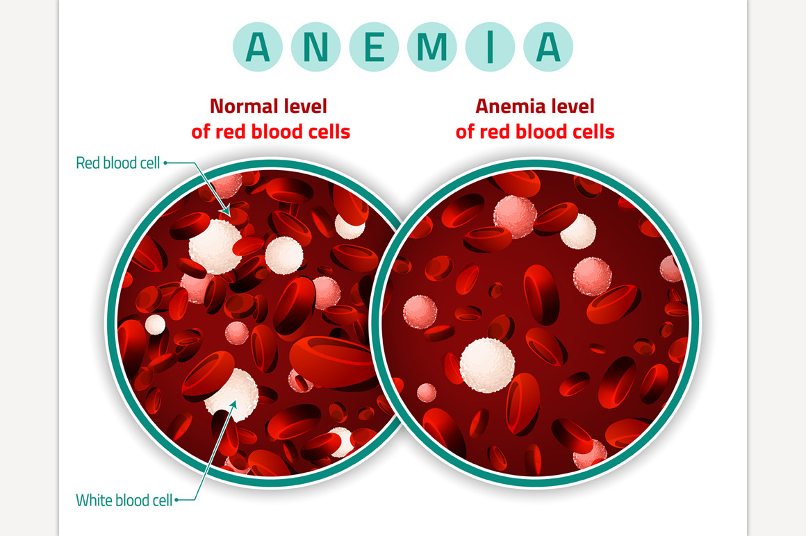 anemia-level-of-blood-cells-healthcare-illustrations-creative-market