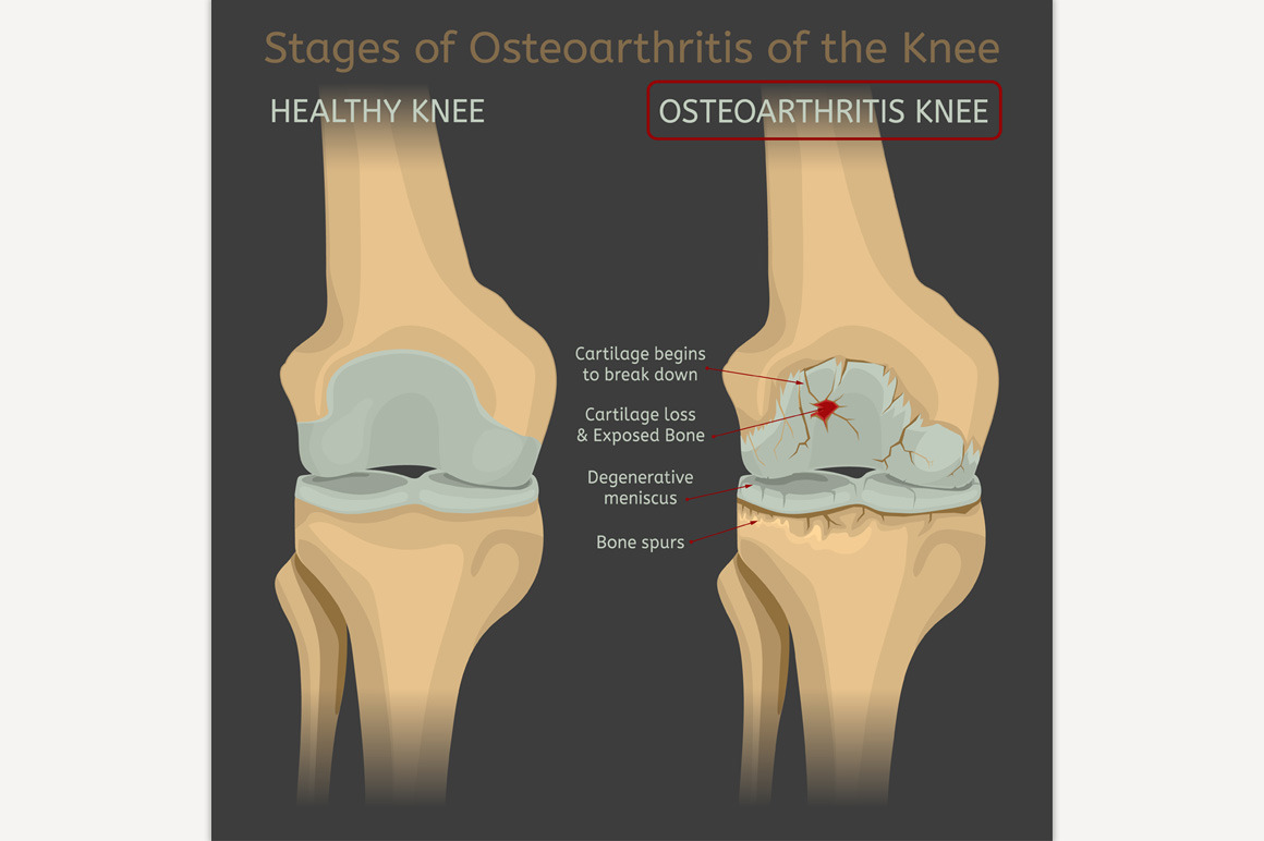 dissertation knee osteoarthritis