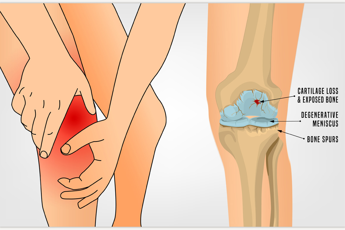 osteoarthritis-knee-poster-healthcare-illustrations-creative-market