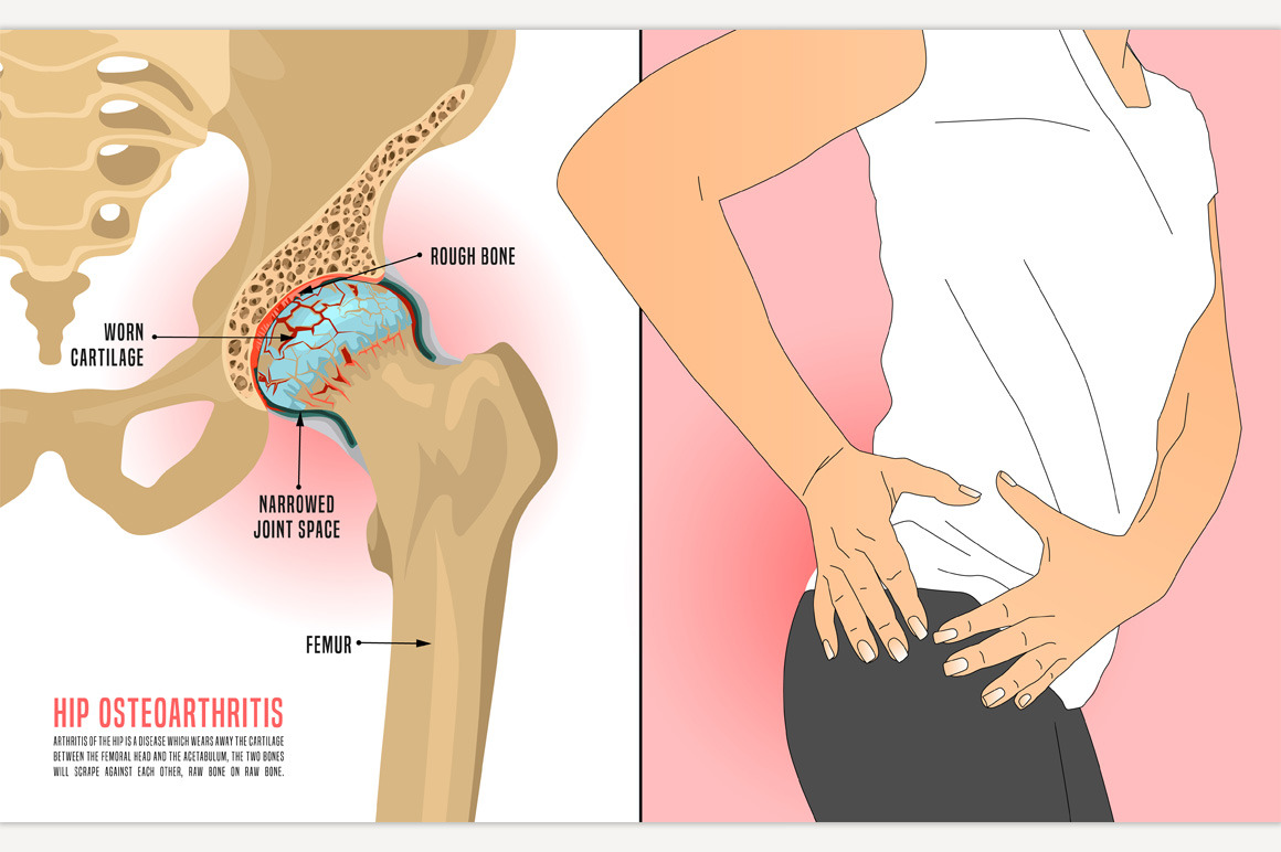 Hip Osteoarthritis Infographic Photoshop Graphics ~ Creative Market