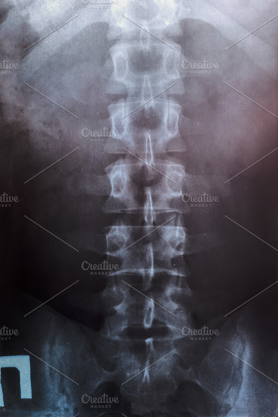 Снимок позвоночника. Мос поясничного отдела позвоночника рентген. Lumbar Spine x ray. Рентген поясничного отдела позвоночника защемление. Позвонки поясничного отдела позвоночника на рентгене.