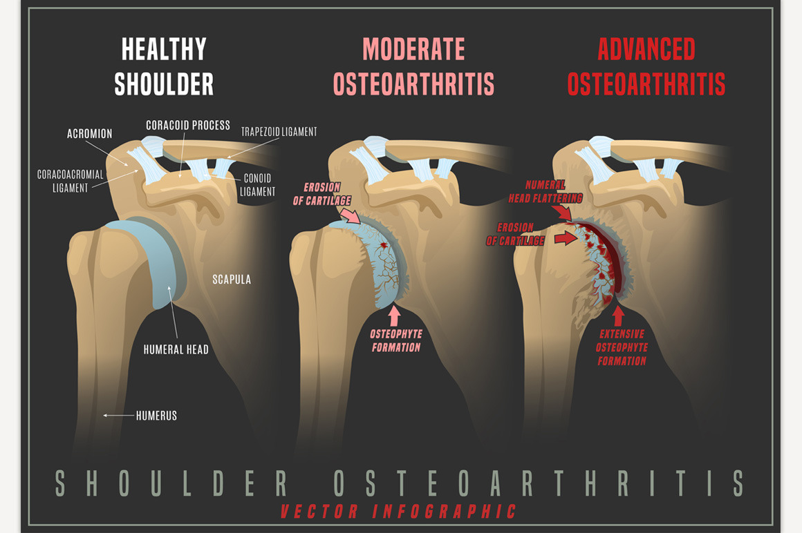 Shoulder osteoarthritis infographic Healthcare Illustrations